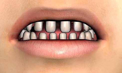 teeth problem with justin - Daz 3D Forums